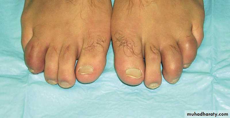 Spondeloarthropathy