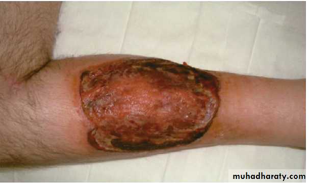 Spondeloarthropathy