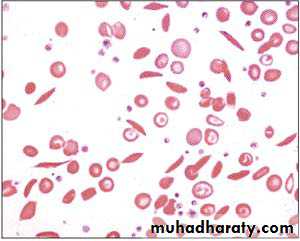 hemoglobinopathies