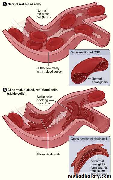 hemoglobinopathies