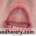Chicken pox Herpes zoster