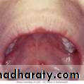 Chicken pox Herpes zoster