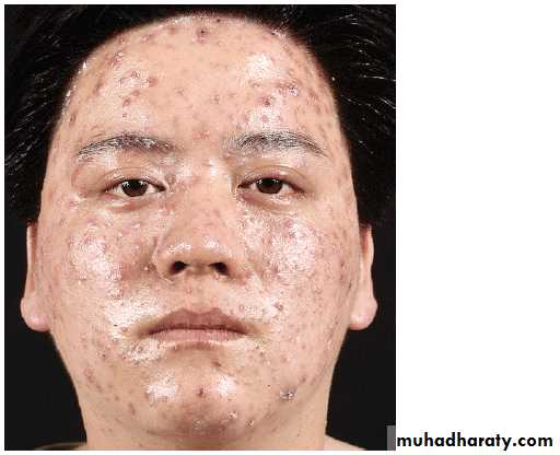 Chicken pox Herpes zoster