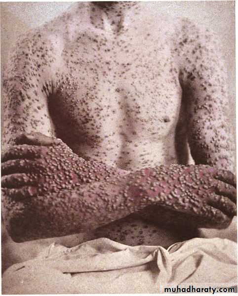 Chicken pox Herpes zoster