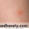 Chicken pox Herpes zoster