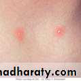 Chicken pox Herpes zoster