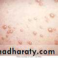 Chicken pox Herpes zoster