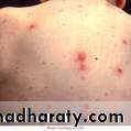 Chicken pox Herpes zoster