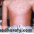 Chicken pox Herpes zoster