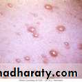 Chicken pox Herpes zoster