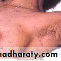 Chicken pox Herpes zoster