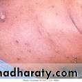 Chicken pox Herpes zoster