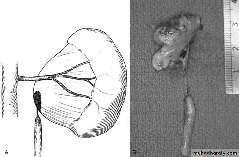 Renal surgical infections