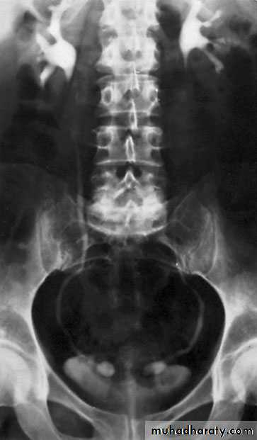 Renal surgical infections
