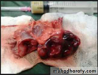Renal surgical infections