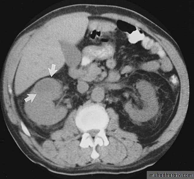 Renal surgical infections