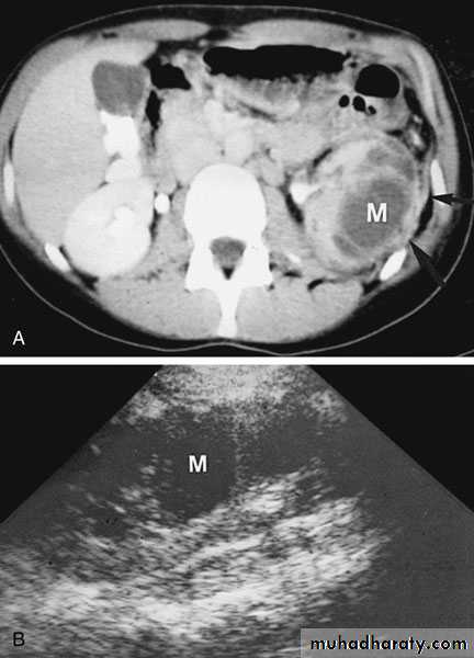 Renal surgical infections