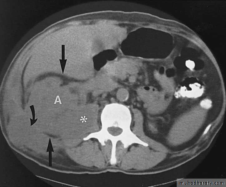 Renal surgical infections