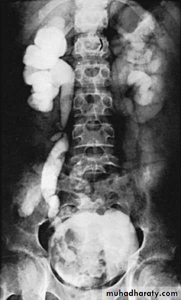 Renal surgical infections