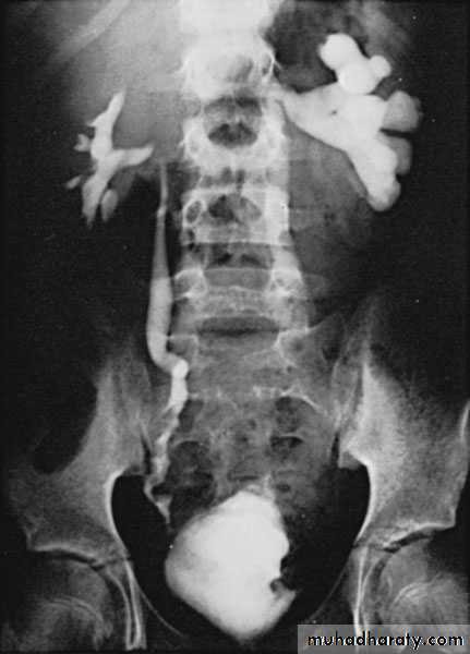 Renal surgical infections