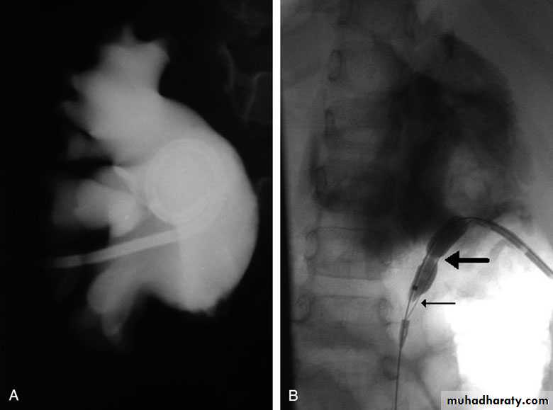 Renal surgical infections