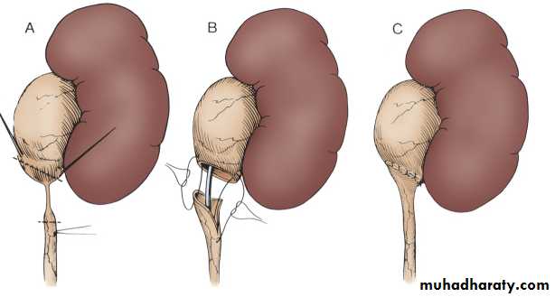 Renal surgical infections