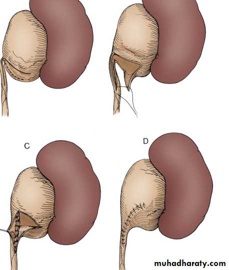 Renal surgical infections