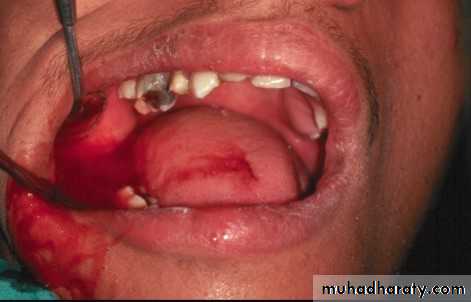 Local anesthesia vasoconstrictor