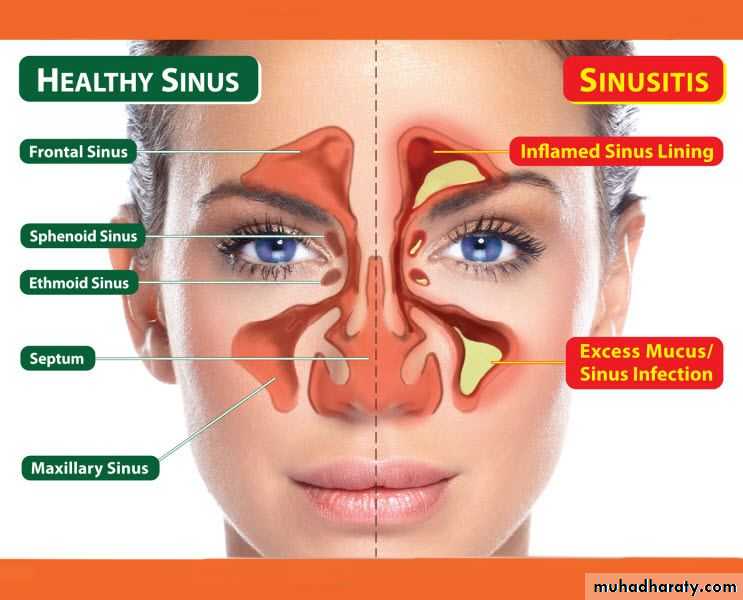 acute and chronic rhinitis