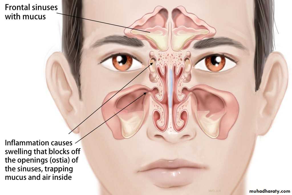 acute and chronic rhinitis