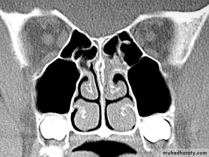 acute and chronic rhinitis