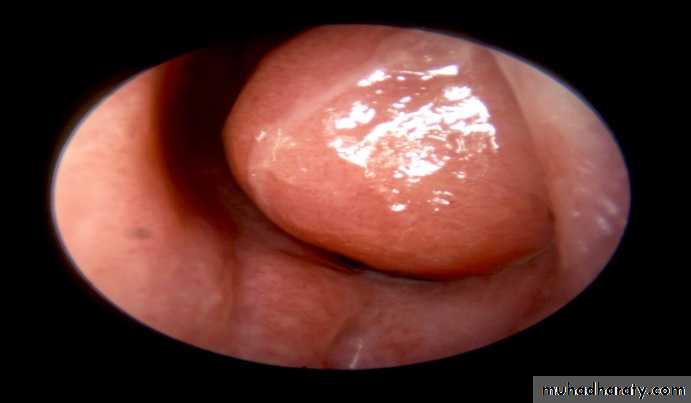 acute and chronic rhinitis