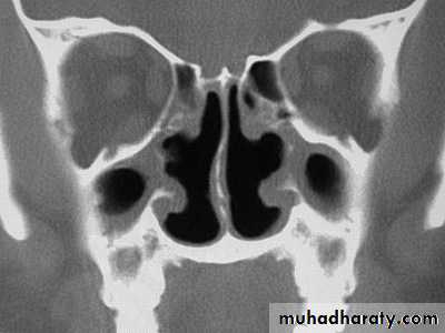 acute and chronic rhinitis