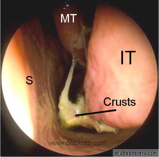 acute and chronic rhinitis