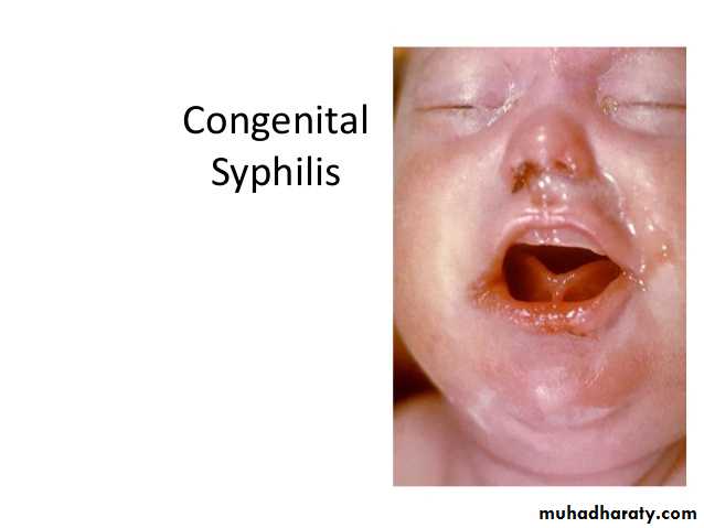 acute and chronic rhinitis