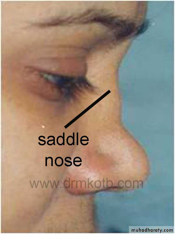 acute and chronic rhinitis
