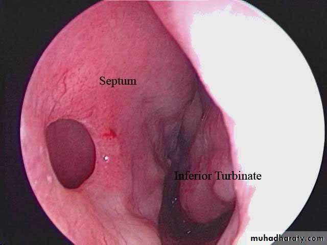 acute and chronic rhinitis