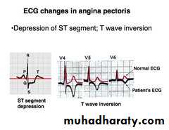 Ischemic Heart diseases