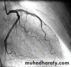 Ischemic Heart diseases
