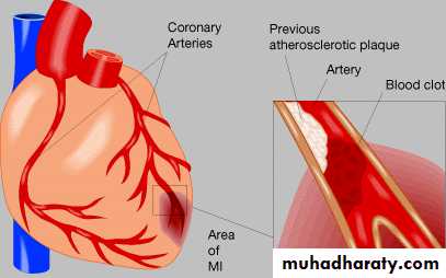 Ischemic Heart diseases
