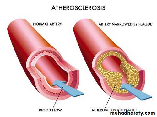 Ischemic Heart diseases
