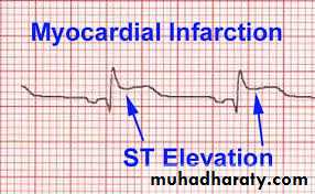 Ischemic Heart diseases