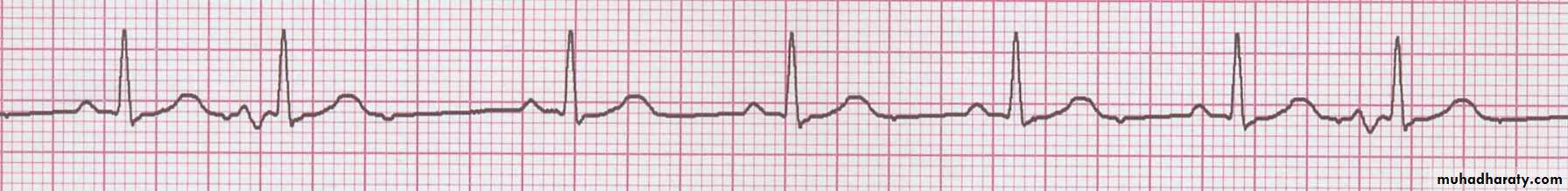cardiac arrhythmia 2