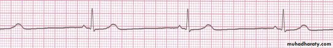 cardiac arrhythmia 2