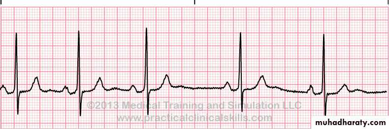 cardiac arrhythmia 2