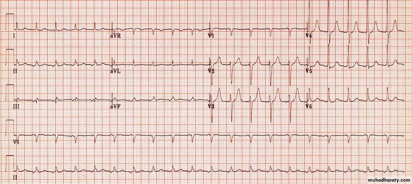 cardiac arrhythmia 2