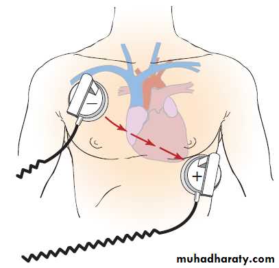 cardiac arrhythmia 2