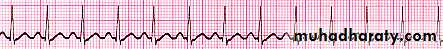 cardiac arrhythmia 2