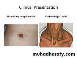Esoph and gastric tumor