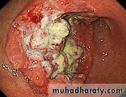 Esoph and gastric tumor